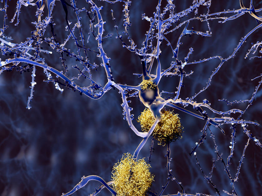 csm 150922 Neuron mit Amyloid plaques Fotolia 89244067 M 285d6e2a36