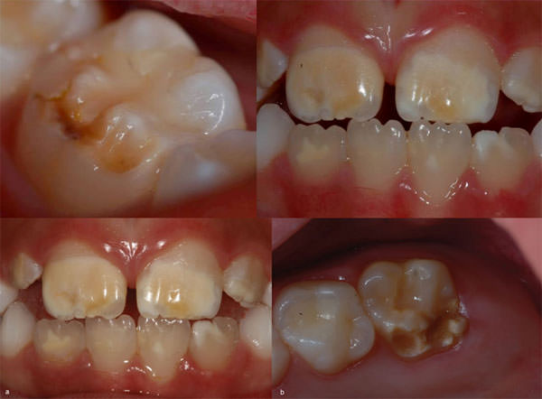 hipoplasia esmalte dental