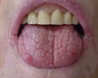 LENGUA FISURADA